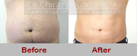 male liposuction before and after