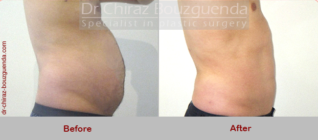 male liposuction before and after