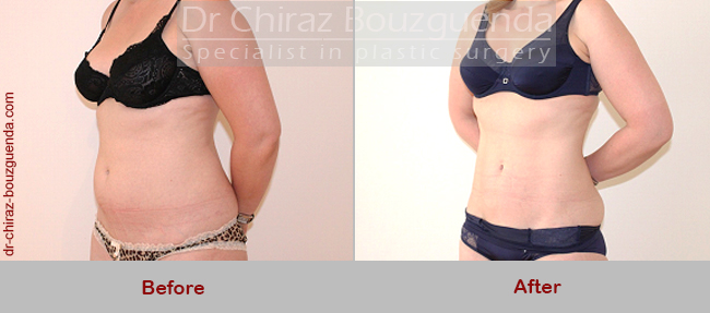 liposuction before and after photos