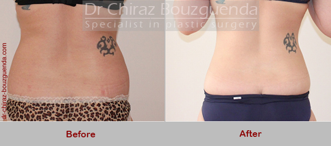 liposuction before and after photos