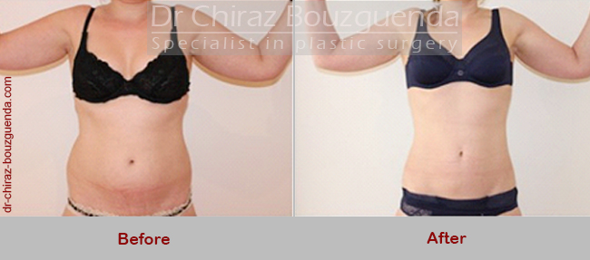 liposuction before and after photos