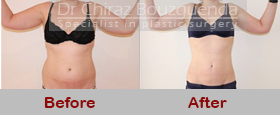 liposuction before and after photos