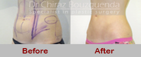 liposuction before after photos