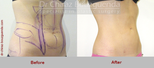 liposuction before after photos