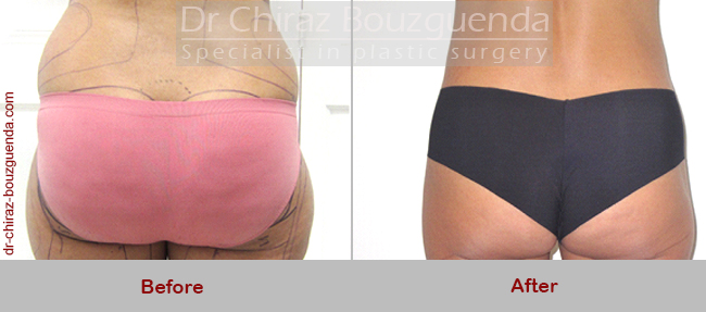 liposuction before after pictures