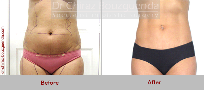 liposuction before after pictures