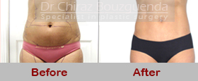 liposuction before after pictures