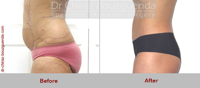 liposuction before after pictures
