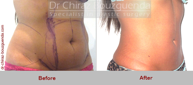 liposuction before after