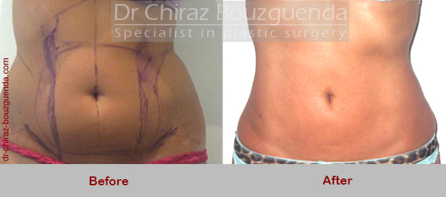 liposuction before after