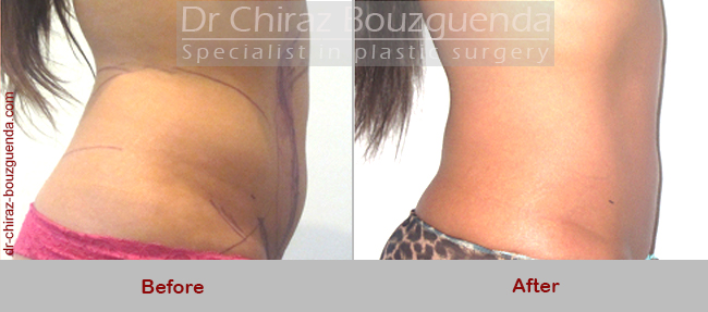 liposuction before after