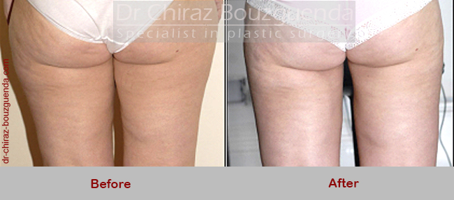 liposuction before after