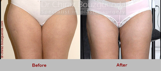 liposuction before after