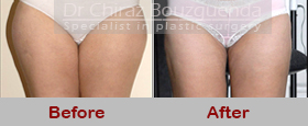 liposuction before after