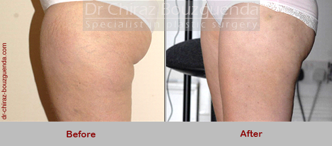 liposuction before after