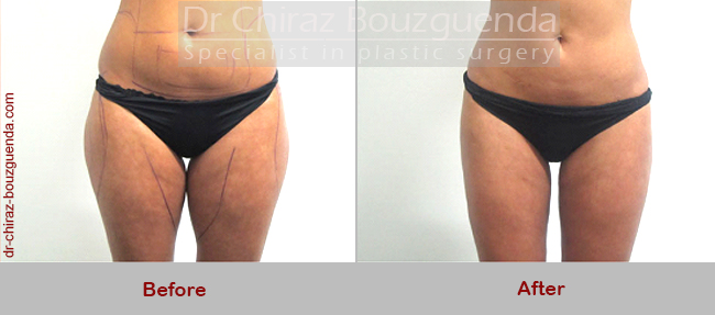 liposuction before after