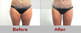 liposuction before after