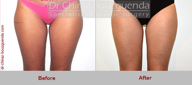 liposuction before after