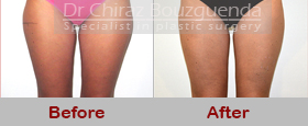 liposuction before after