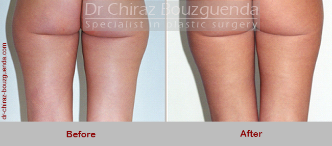 liposuction before after