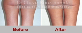 liposuction before after