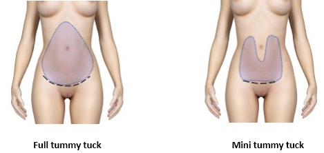 tummy tuck abroad cost