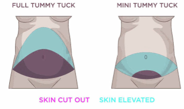  tummy tuck abroad