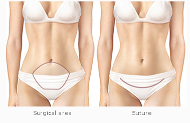 tummy tuck surgery abroad