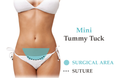  tummy tuck surgery tunisia