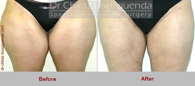 thigh lift before after photos