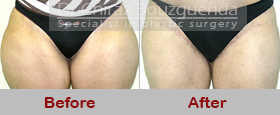 thigh lift before after