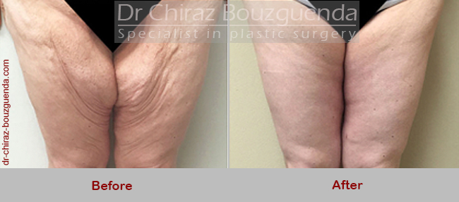 thigh lift surgery before after