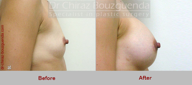 breast augmentation before and after pictures