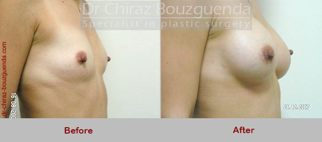 breast augmentation before and after