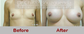 breast augmentation before and after