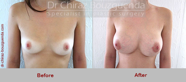 breast augmentation before and after photos
