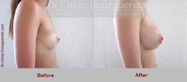 breast augmentation before and after