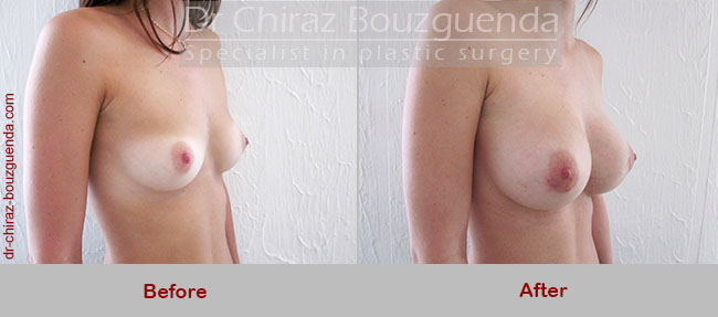 breast augmentation before and after