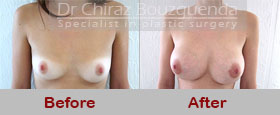 breast augmentation before and after