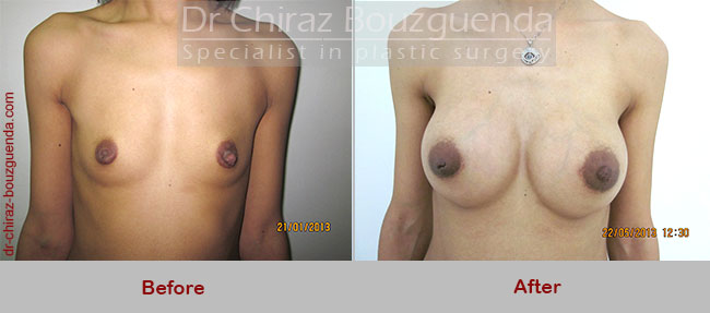 breast augmentation photos