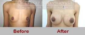 breast augmentation before after