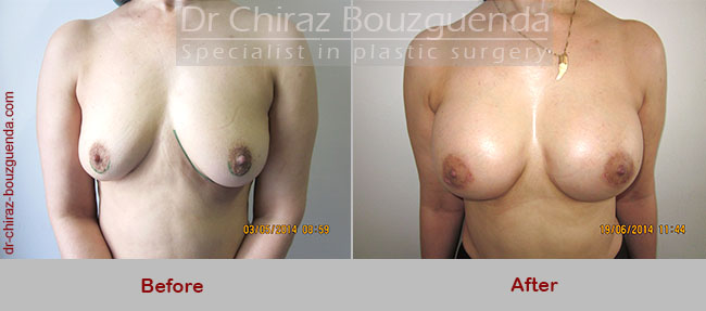 breast augmentation before and after abroad