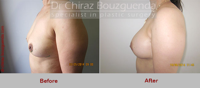 breast augmentation before and after tunisia