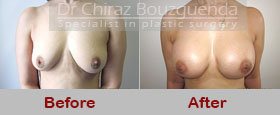 breast augmentation before and after