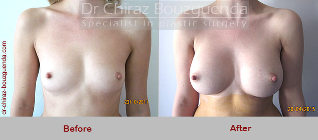 breast augmentation before and after