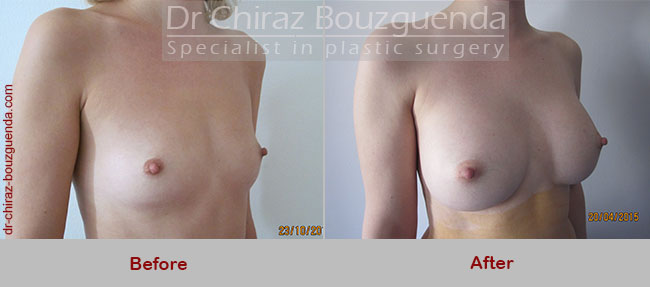 breast augmentation before and after