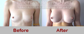 breast augmentation before and after