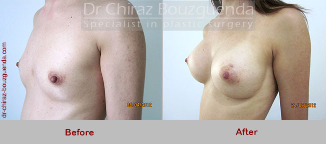 breast augmentation before and after