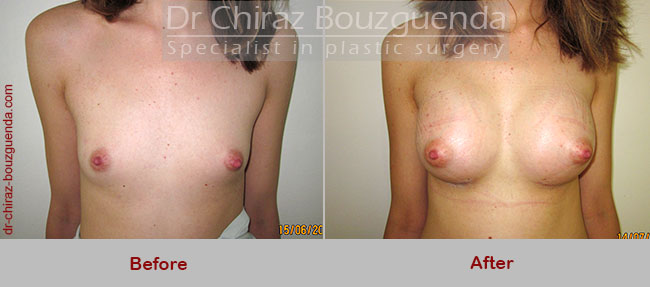 breast implants before and after