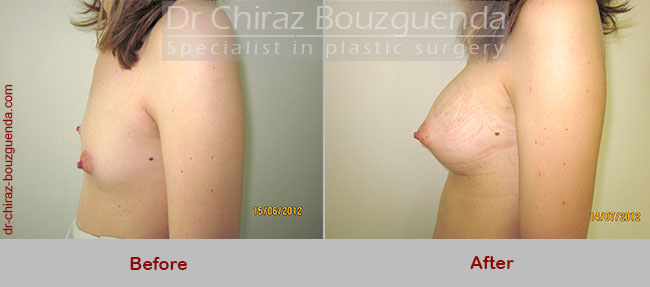 breast augmentation before and after pictures